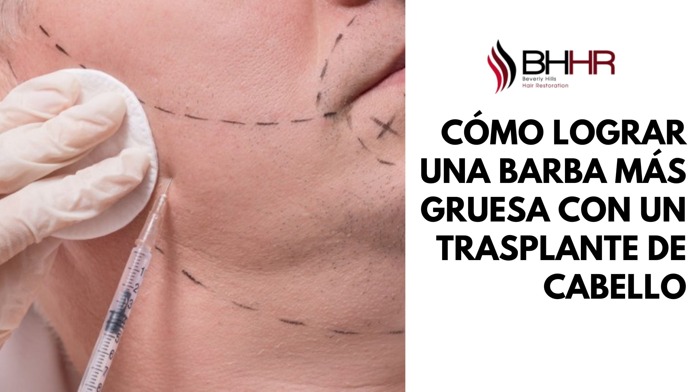 trasplante de barba