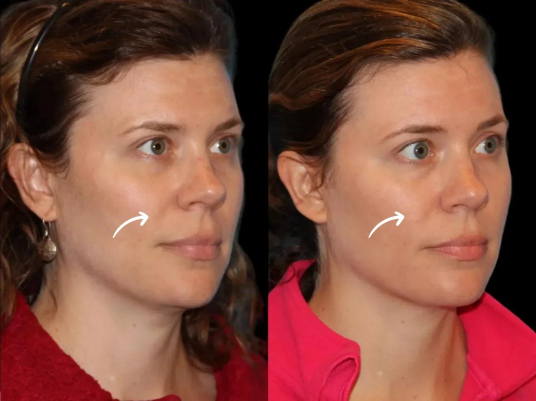 Best Doctors in Dubai Offer Sculptra with Minimal Downtime