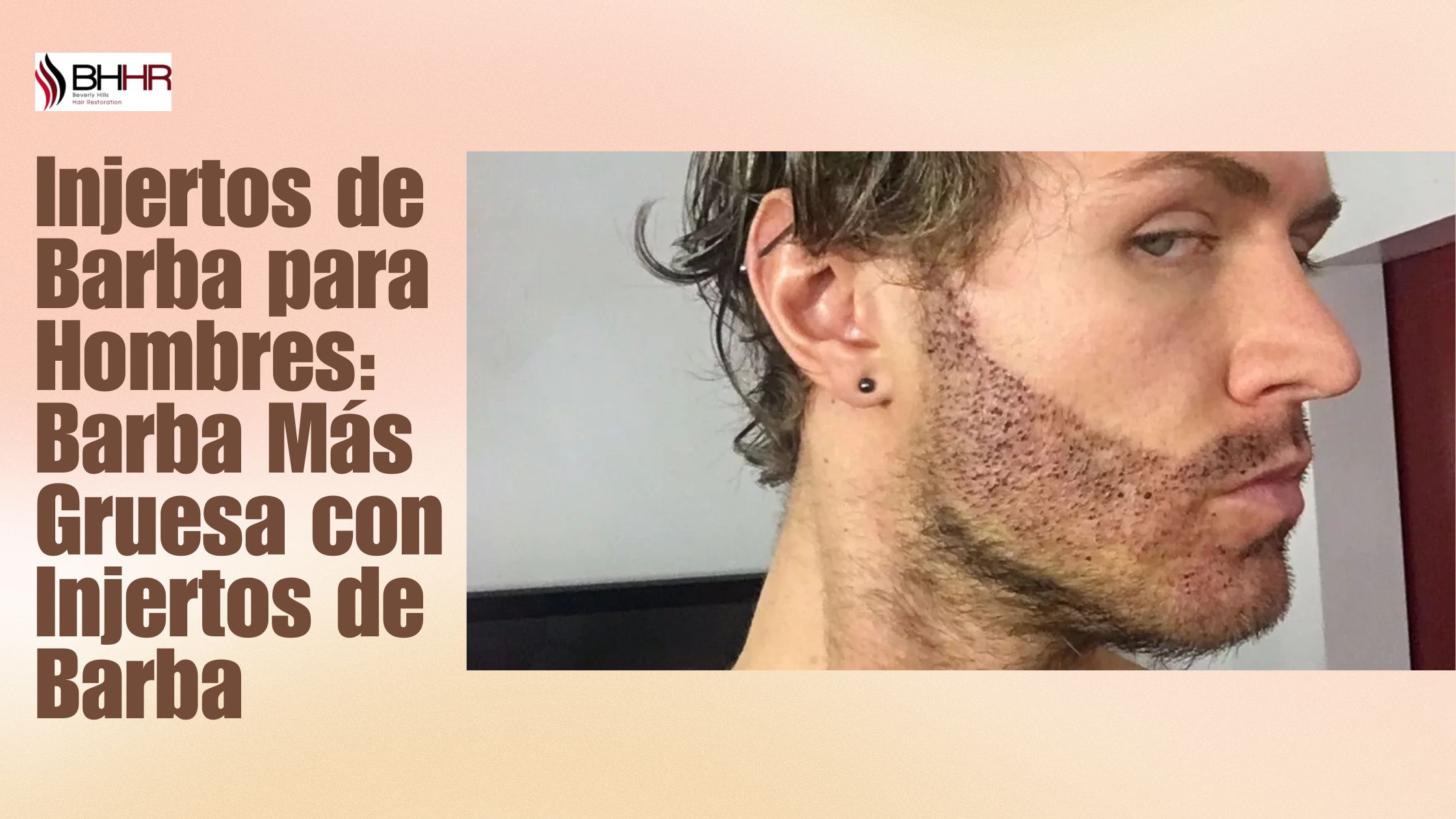injertos de barba