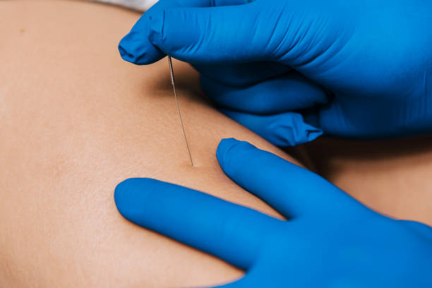 Dry Needling for Muscle Pain Relief