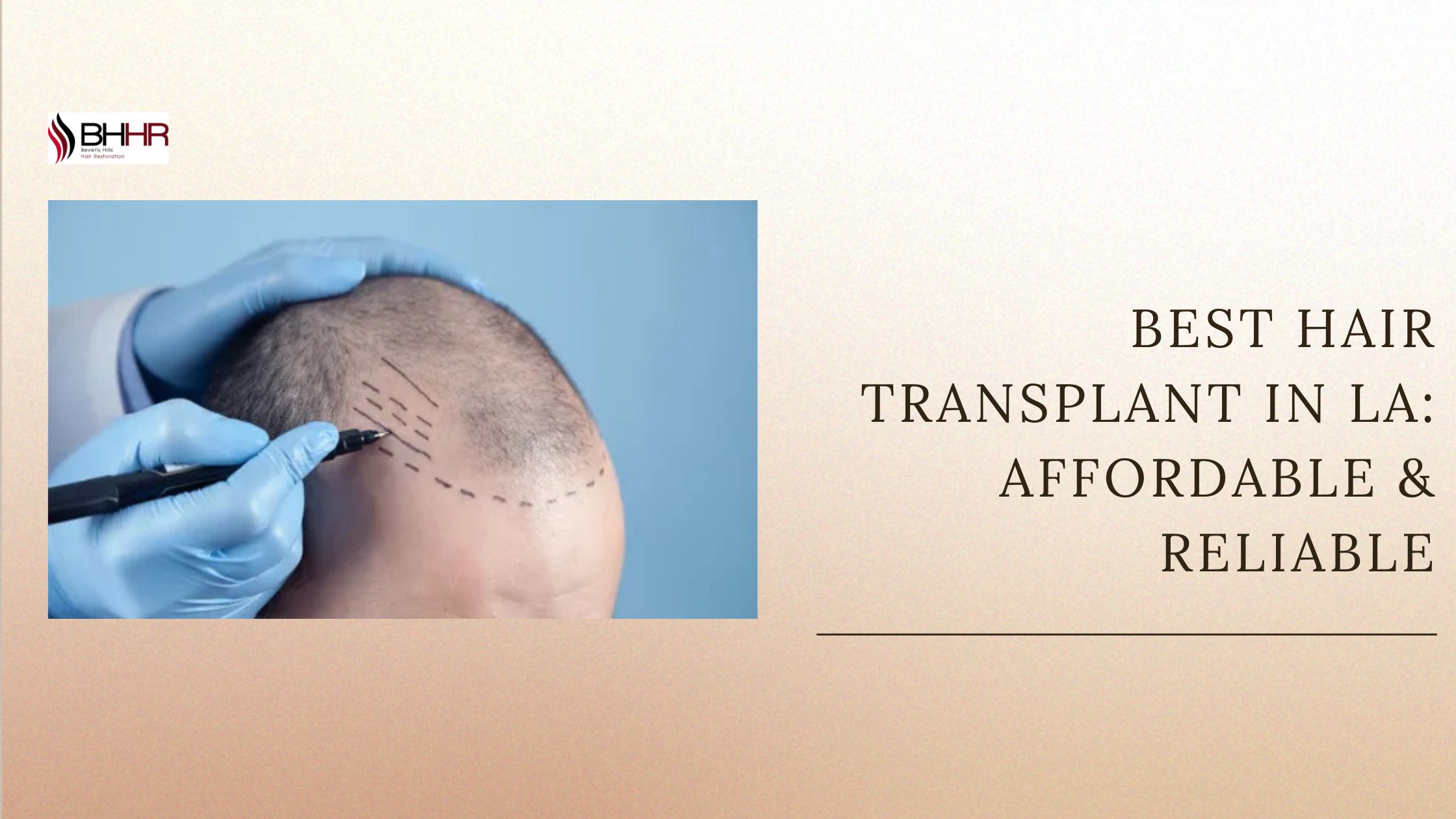 best hair transplant in la