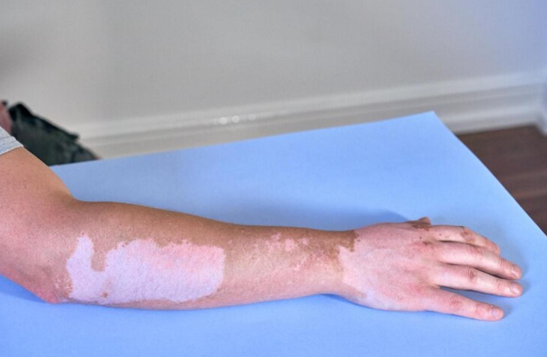 vitiligo in hand