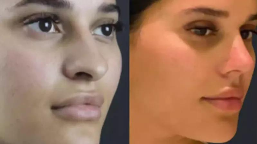 rhinoplasty in dubai